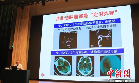 中国科学院院士、国家神经系统疾病临床医学研究中心主任赵继宗进行科普讲座。北京天坛医院供图